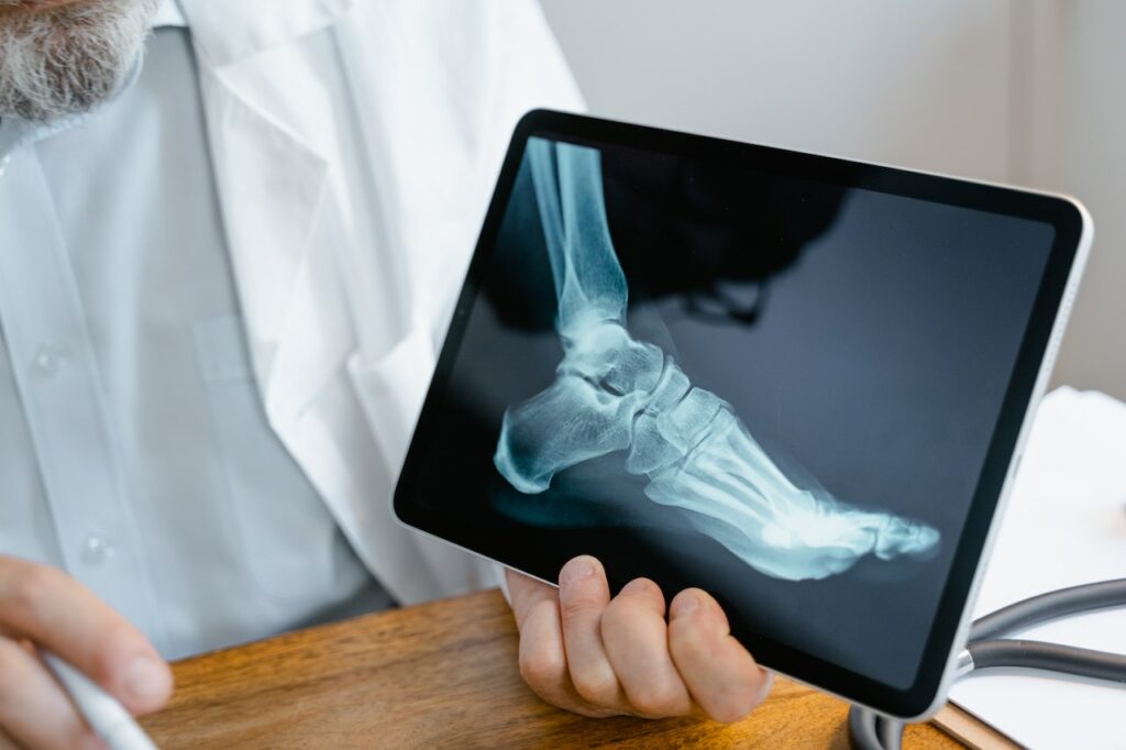ankle fracture x-ray